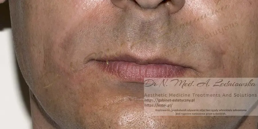 korekcja bruzd nosowo wargowych Mężczyzna Ledniowska