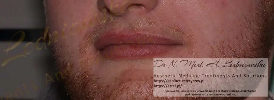 Powiększanie ust u Mężczyzn dr Ledniowski 