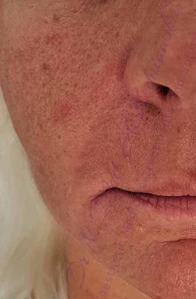 odmladzanie twarzy u starszej osoby ledniowska wypełnione bruzdy nosowo wargowe 
