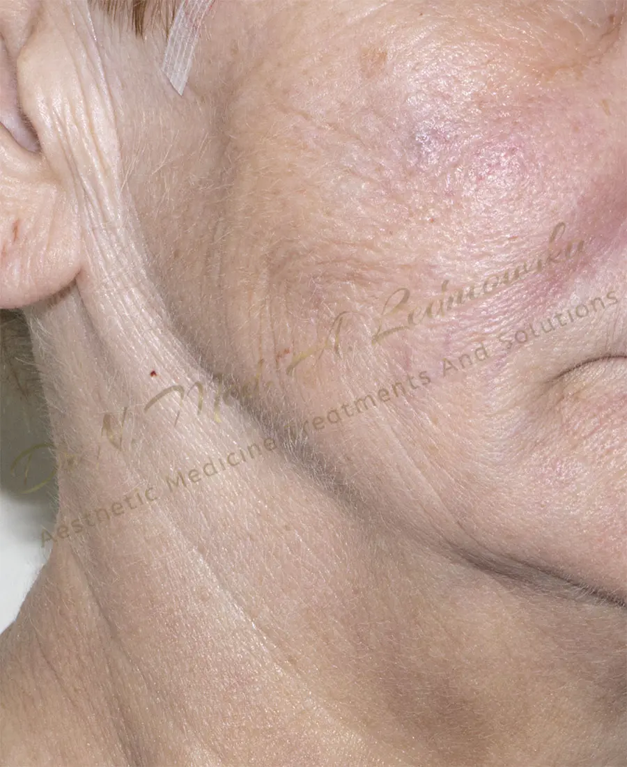 kobieta w średnim wieku lifting twarzy agnieszka ledniowska zabieg gabinet klinika profesjonalnie