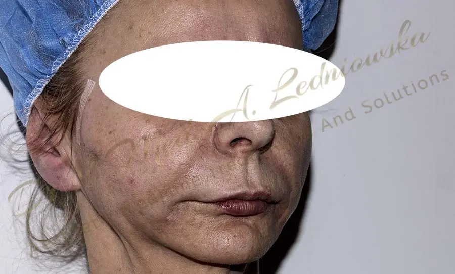kobieta odmłodzić twarz agnieszka ledniowska zabieg gabinet klinika profesjonalnie