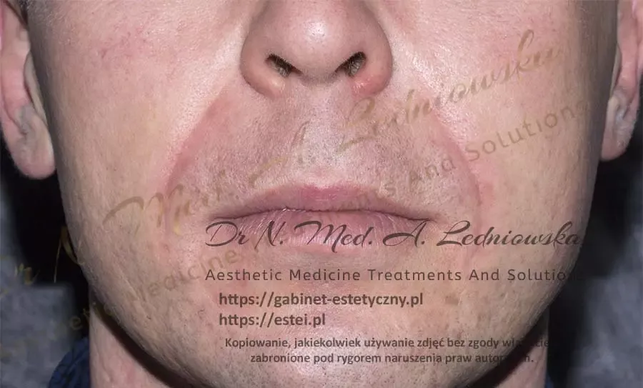Bruzdy nosowo wargowe Mężczyzna Medycyna Estetyczna 