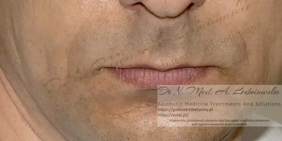 korekcja bruzd nosowo wargowych Mężczyzna Ledniowska
