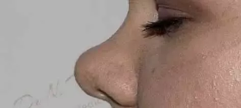 krzywy nos 