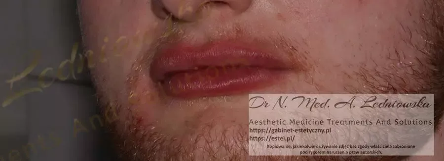 Powiększanie ust u Mężczyzn dr Ledniowski 