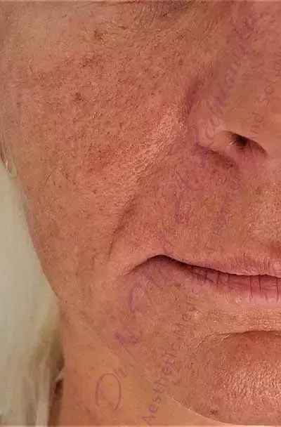 odmladzanie twarzy u starszej osoby ledniowska wypełnione bruzdy nosowo wargowe 