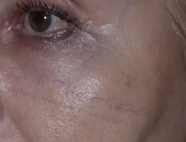 poprawa skóry twarzy koło oczu dr n. med. Agnieszka Ledniowska