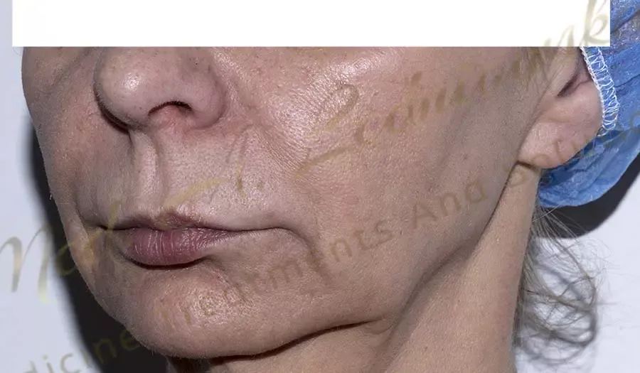 kobieta odmłodzenie twarzy agnieszka ledniowska zabieg gabinet klinika profesjonalnie