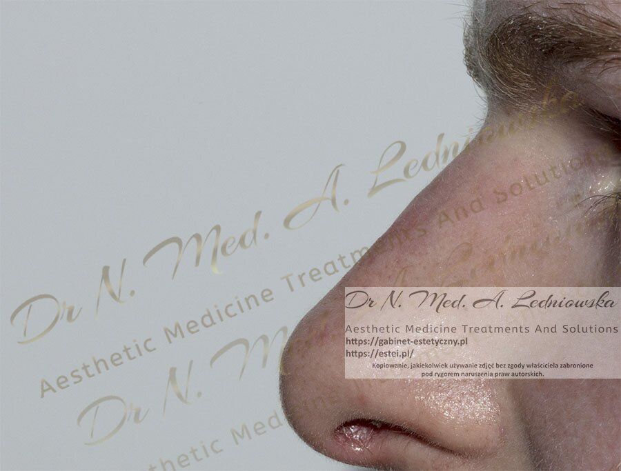 Nos niechirurgiczna zmiana kształtu Mężczyzna Medycyna Estetyczna