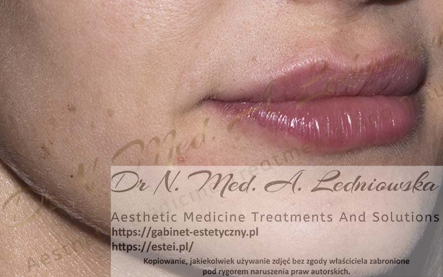 dr n. med. Agnieszka Ledniowska usta - powiekszanie modelowanie warg zabieg