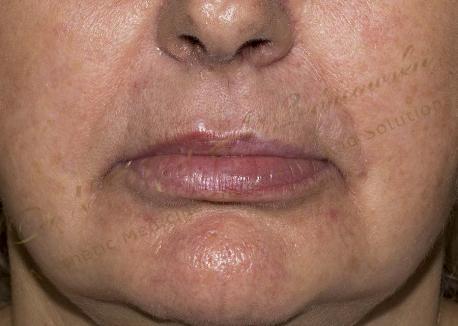 Jednoczesne wypełnianie bruzd-nosowo wargowych i powiększanie ust